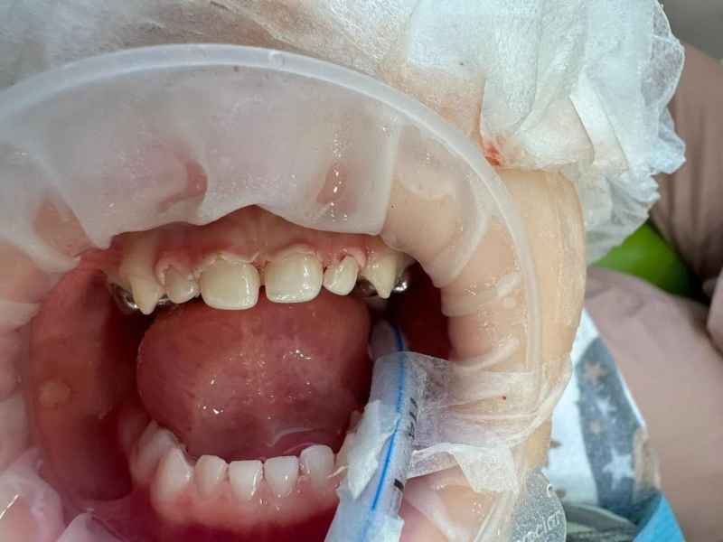 Хайдарова_Ребенок 2,5 года, множественный кариес молочных зубов: фото после