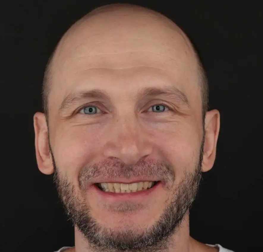 Доктор Кравченко и Чаюков_Восстановление жевательной функции зубов в Тюмени: фото после
