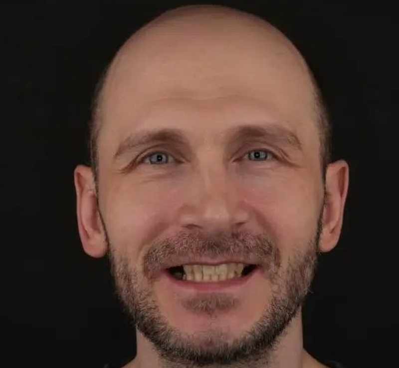  Доктор Кравченко и Чаюков_Восстановление жевательной функции зубов в Тюмени: фото до