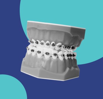 Выравнивание зубов у взрослых: как происходит исправление прикуса и больно ли это